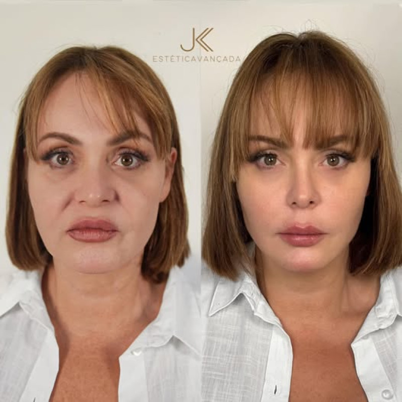 Gaby Spanic muestra su rostro tras someterse a un rejuvenecimiento facial y se vuelve viral en redes