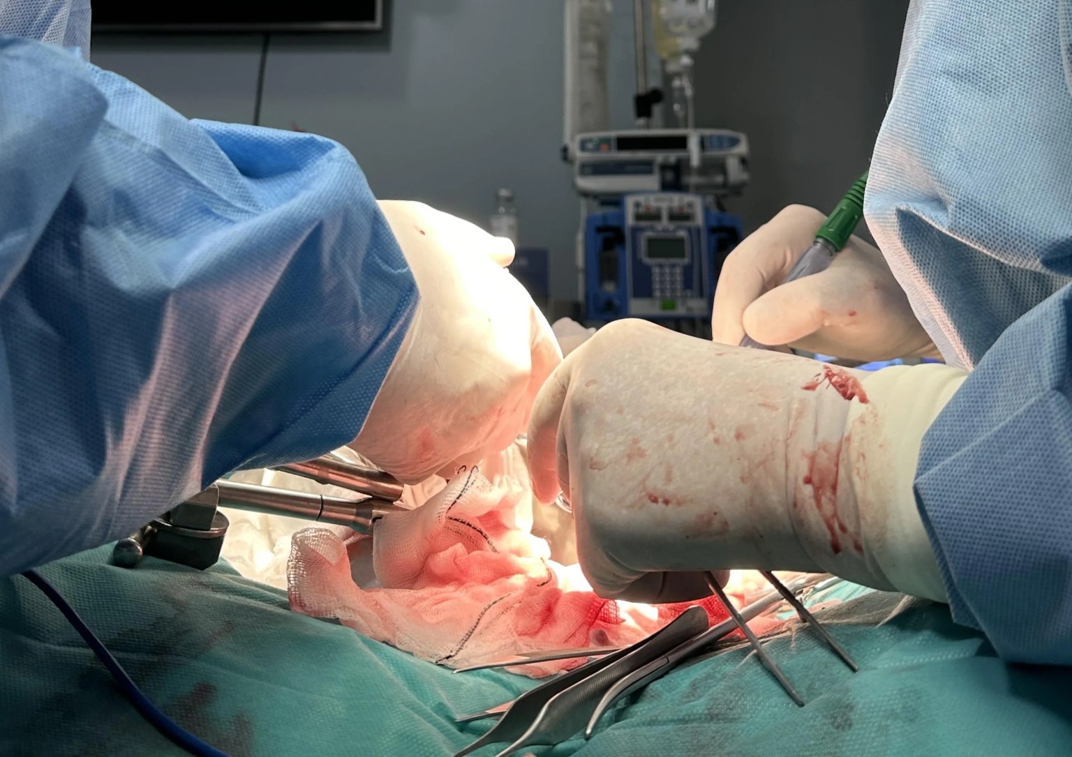 Logran primer trasplante a cerdos de riñones porcinos modificados con organoides humanos